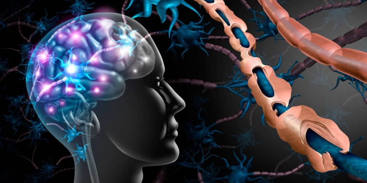 Esclerosis múltiple enfermedad estigmatizada y rodeada de mitos