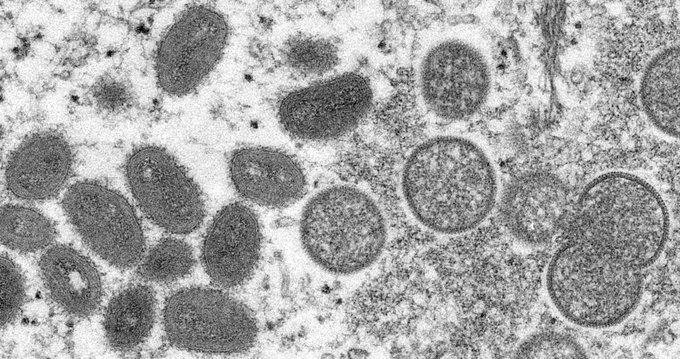 OMS declara emergencia internacional por viruela del mono